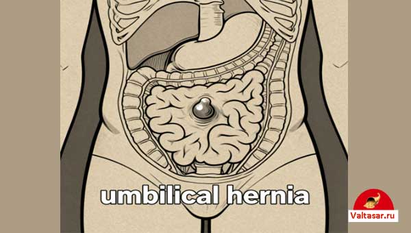 анатомия грыжи